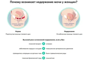 Почему возникает недержание мочи у женщин