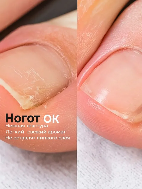 Эффект от применения мази Ноготок от грибка ногтей