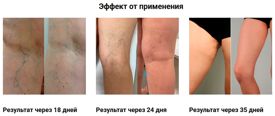 Эффект от применения препарата Варифит геля от варикоза