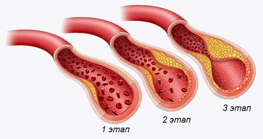Этапы формирования холестериновой бляшки в организме человека