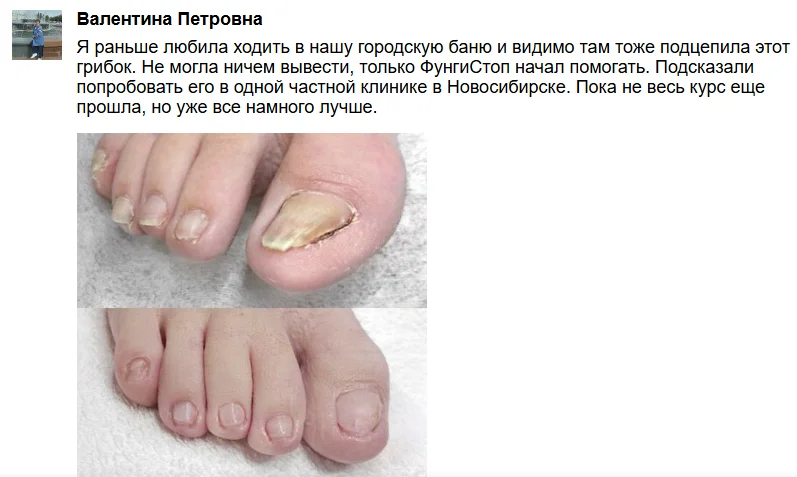 Отзыв реального покупателя о препарате ФунгиСтоп от грибка ногтей на ногах №5