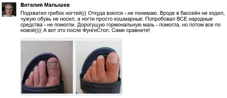 Отзыв реального покупателя о препарате ФунгиСтоп от грибка ногтей на ногах №7