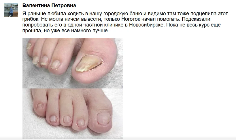 Отзыв покупателя о мази Ноготок от грибка ногтей №1