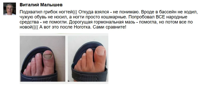 Отзыв покупателя о мази Ноготок от грибка ногтей №2