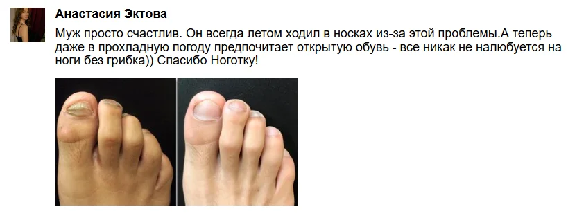 Отзыв покупателя о мази Ноготок от грибка ногтей №4