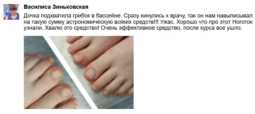 Отзыв покупателя о мази Ноготок от грибка ногтей №6
