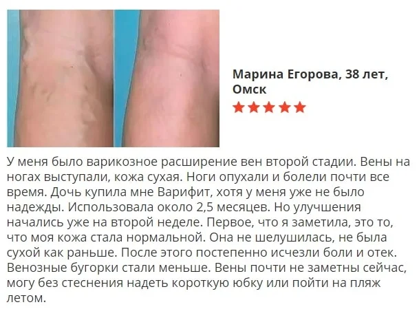 Отзыв покупателя о препарате Варифит гель от варикоза №5