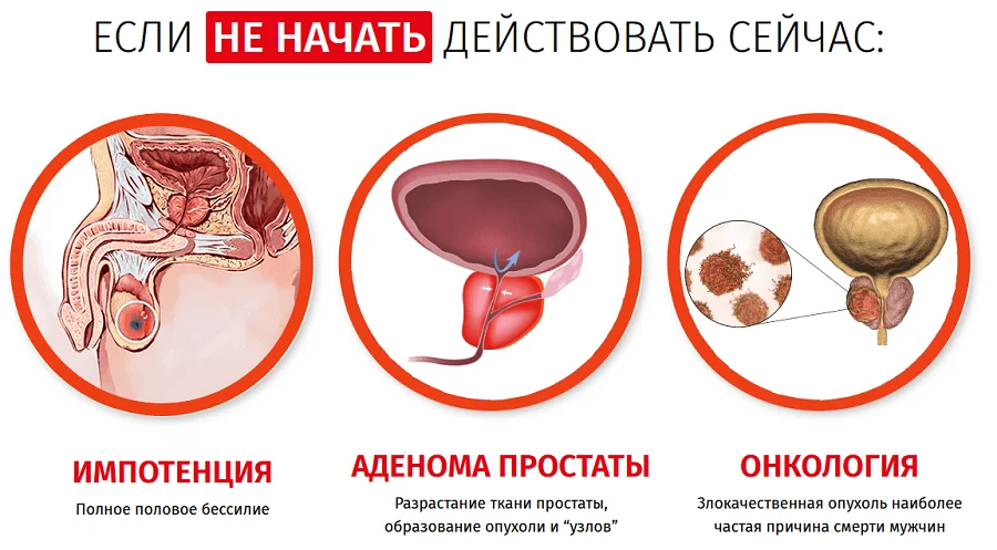 Последствия нелеченного простатита