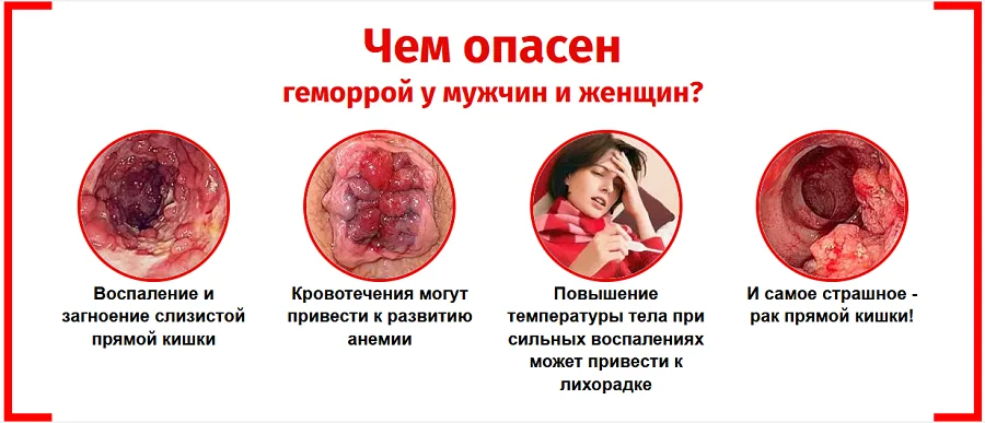 Чем опасен геморрой у мужчин и женщин?