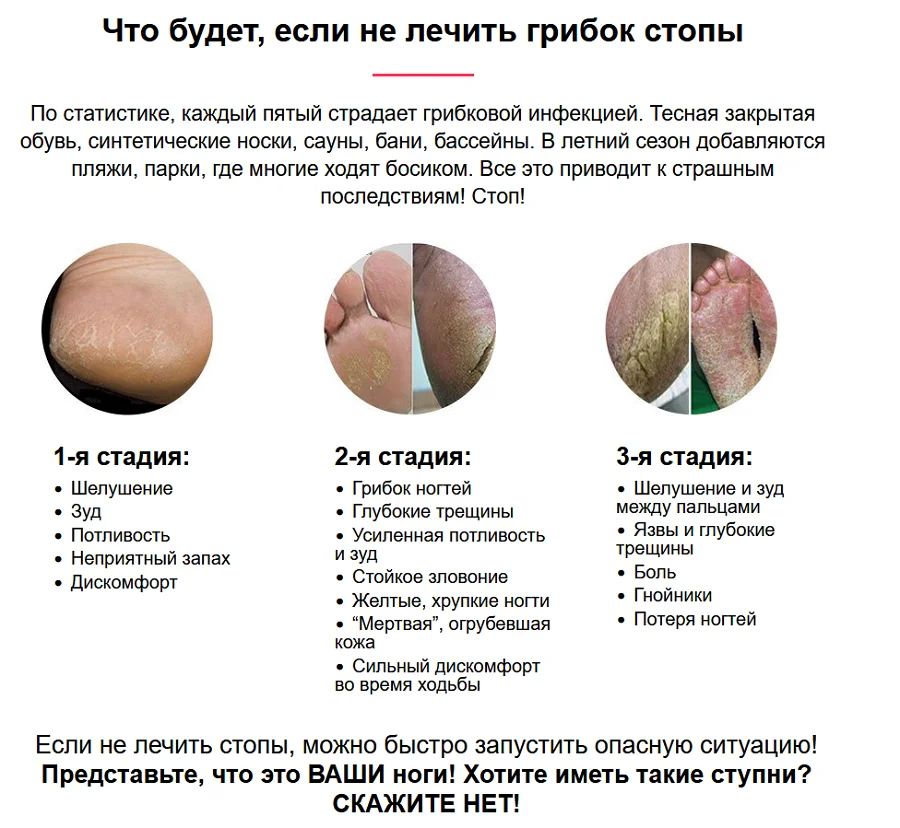 Что будет, если не лечить грибок стопы