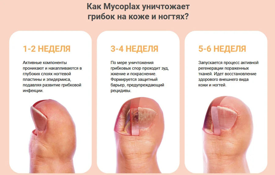 Как гель от грибка Микоплакс уничтожает грибок на коже и ногтях