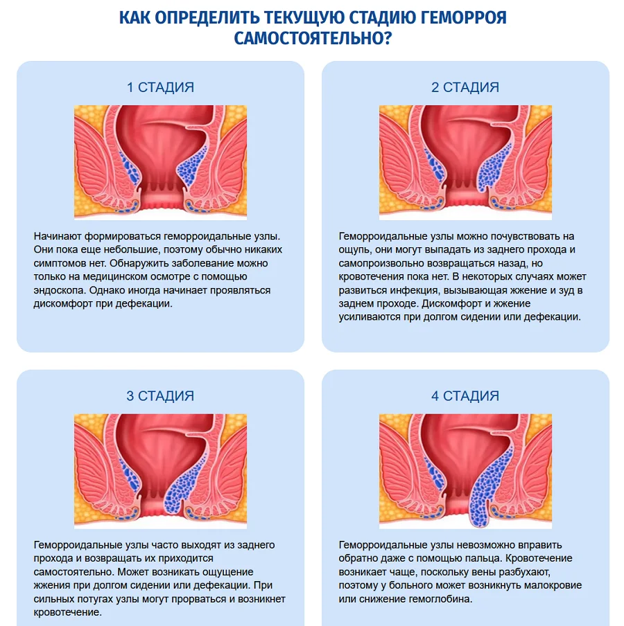 Как определить текущую стадию геморроя самостоятельно?