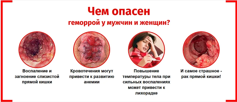 Чем опасен геморрой у мужчин и женщин?