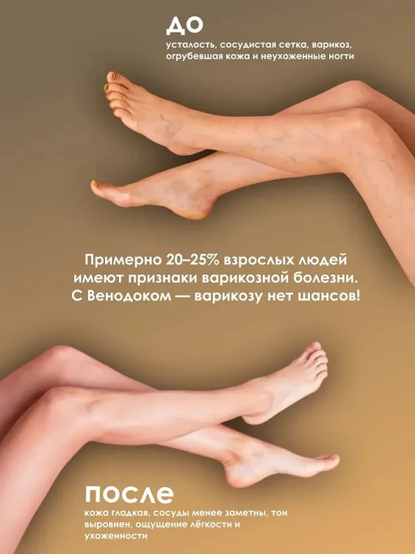 До и после применения Вендок Плюс гель от варикоза