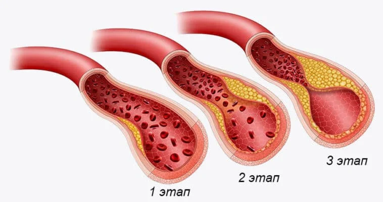 Этапы закупорки сосудов в организме человека