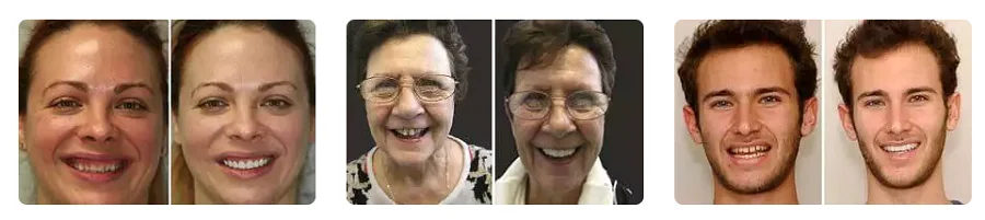 Как выглядят виниры Dent Expert после их установки в ротовую полость