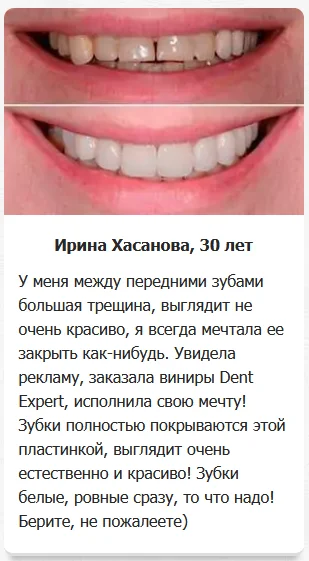 Отзыв реального покупателя о Dent Expert (Дент Эксперт) виниры для зубов №2
