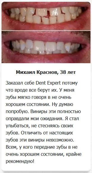Отзыв реального покупателя о Dent Expert (Дент Эксперт) виниры для зубов №3