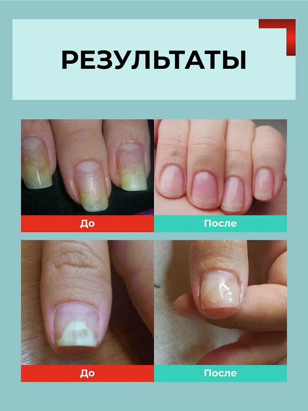 Результаты после применения препарата Миконурил от грибка