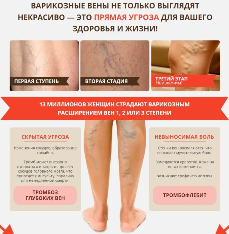 Варикозные вены не только выглядят некрасиво - это ПРЯМАЯ УГРОЗА для вашего здоровья и жизни!