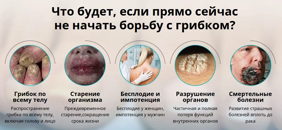 Что будет если прямо сейчас не начать борьбу с грибком?