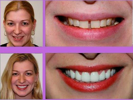 Как выглядят виниры Rusveneer после их установки