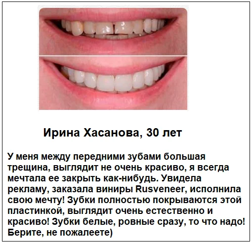 Отзывы реальных покупателей о товаре Rusveneer виниры съемные для зубов №6