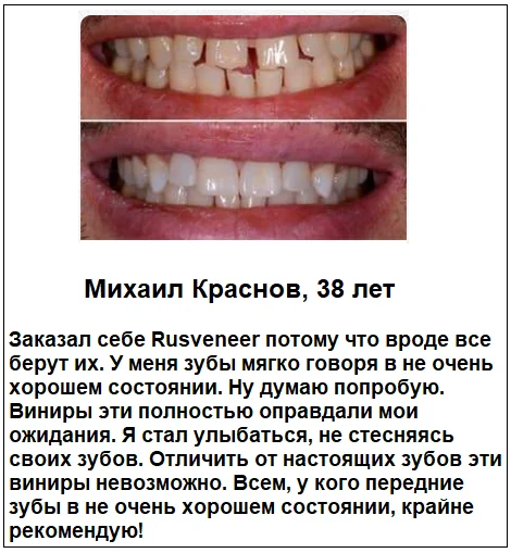 Отзывы реальных покупателей о товаре Rusveneer виниры съемные для зубов №7