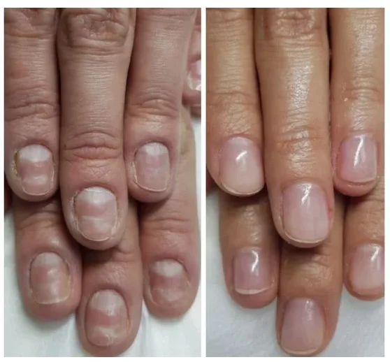 Результаты применения геля Экзифол от грибка ногтей