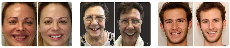 Счастливые покупатели виниров Rusveneer до и после применения