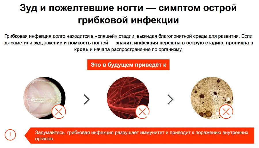 Зуд и пожелтевшие ногти - симптом острой грибковой инфекции