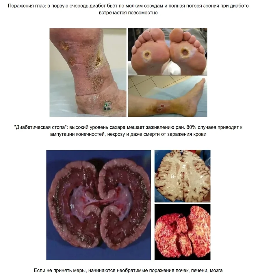 Диабет это серьезная угроза для здоровья человека