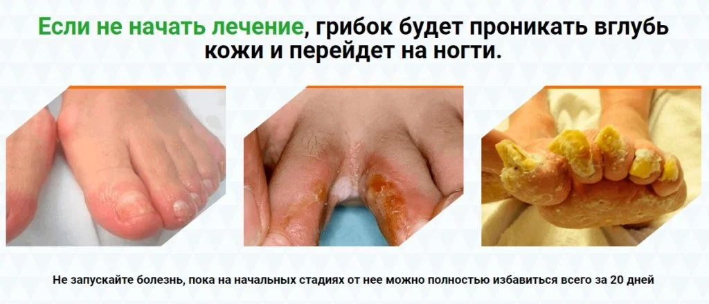 Если не начать лечение, грибок будет проникать вглубь кожи и перейдет на ногти
