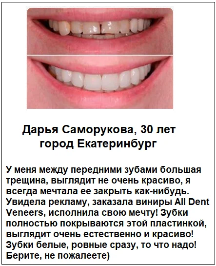 Отзывы реальных покупателей о товаре All Dent Veneers съемные виниры для зубов №2