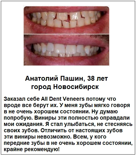 Отзывы реальных покупателей о товаре All Dent Veneers съемные виниры для зубов №3