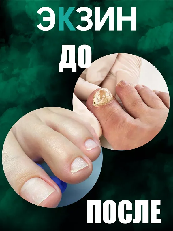 Результаты до и после применения мази от грибка Экзин